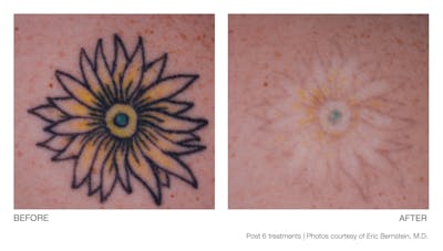 Tattoo Removal Before & After Gallery - Patient 94033575 - Image 1