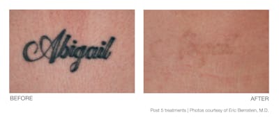 Tattoo Removal Before & After Gallery - Patient 94033576 - Image 1