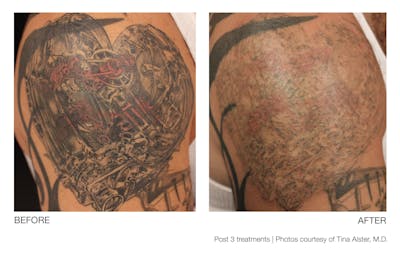 Tattoo Removal Before & After Gallery - Patient 94033577 - Image 1