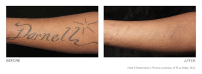 Tattoo Removal Before & After Gallery - Patient 94033578 - Image 1