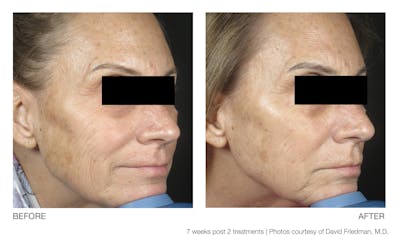 Resolve Laser Peel Before & After Gallery - Patient 94033809 - Image 1