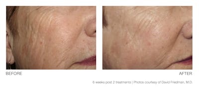 Resolve Laser Peel Before & After Gallery - Patient 94033810 - Image 1