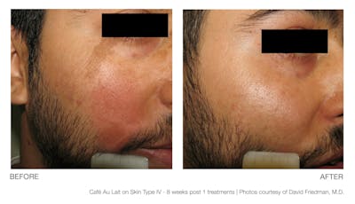 Resolve Laser Peel Before & After Gallery - Patient 94033811 - Image 1