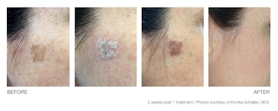 Resolve Laser Peel Before & After Gallery - Patient 94033812 - Image 1