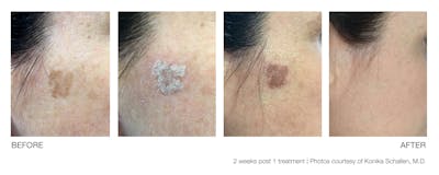 Resolve Laser Peel Before & After Gallery - Patient 94033812 - Image 1