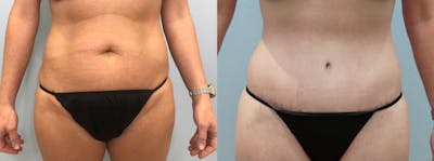 Tummy Tuck Before & After Gallery - Patient 94880575 - Image 1