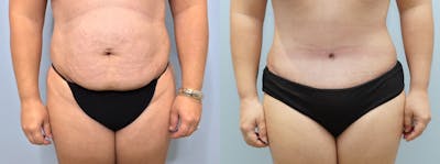 Tummy Tuck Before & After Gallery - Patient 94880780 - Image 1