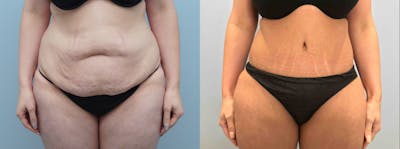 Tummy Tuck Before & After Gallery - Patient 94880860 - Image 1