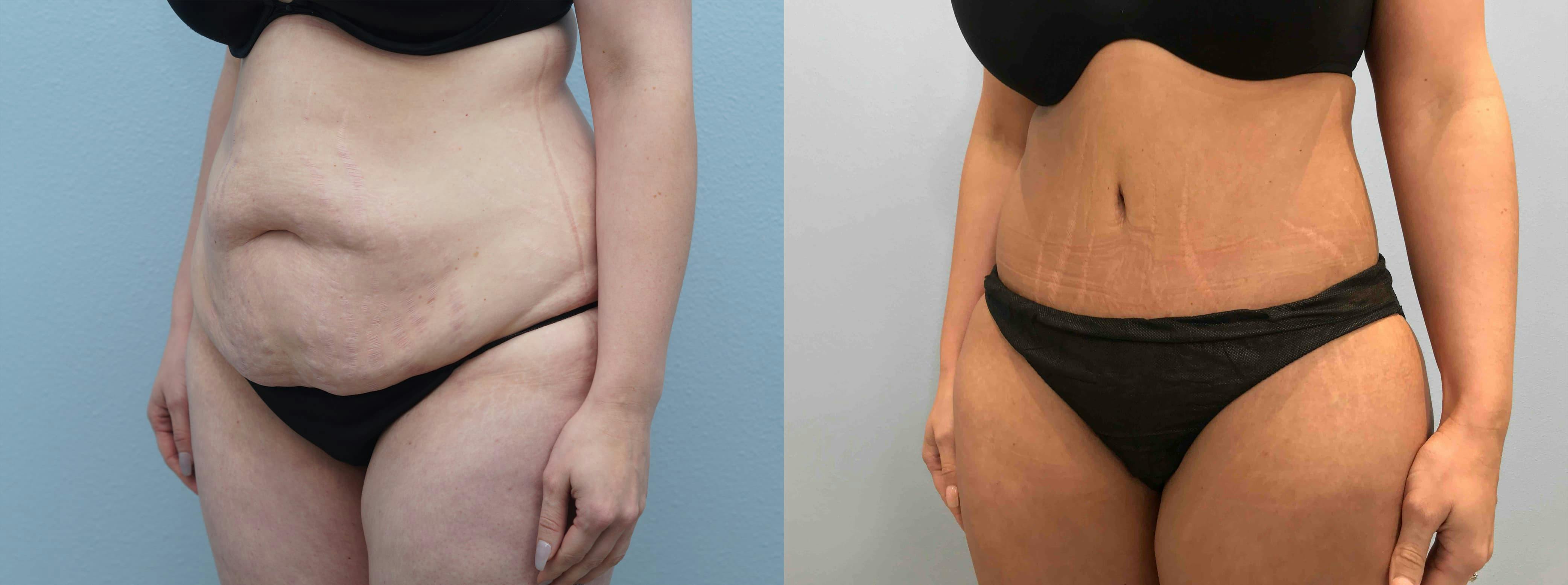 Tummy Tuck Gallery - Patient 94880860 - Image 3