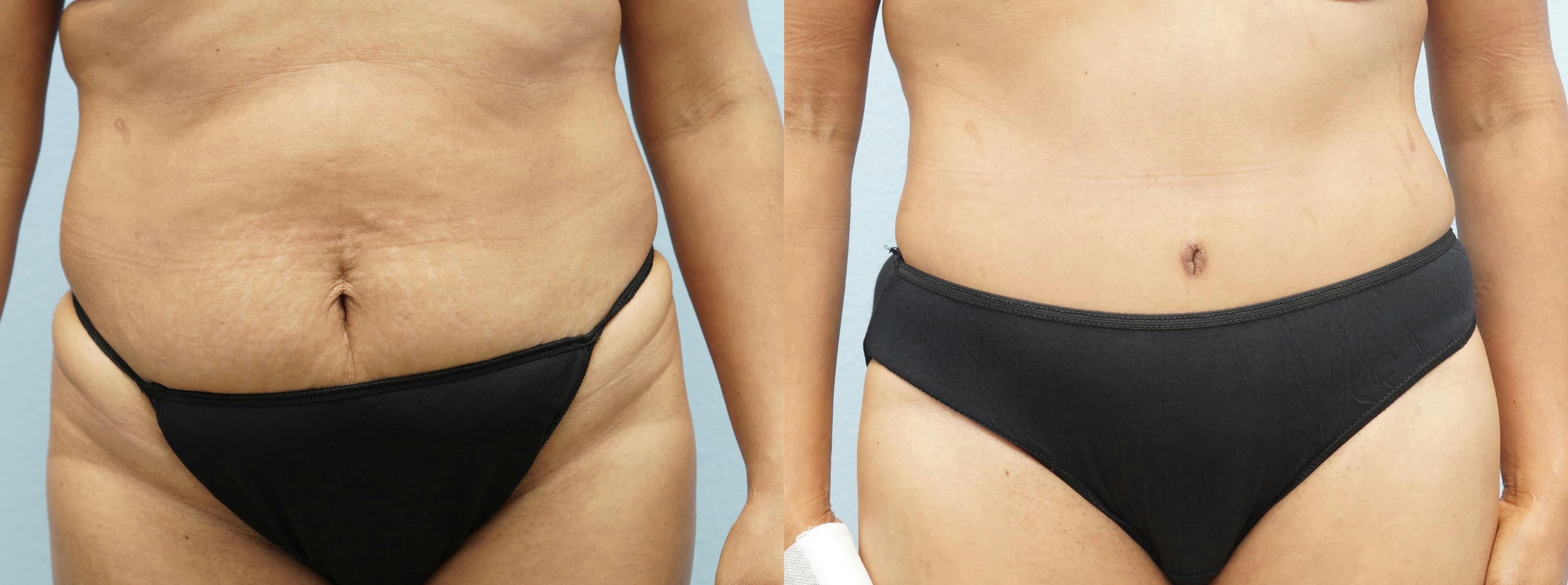 Tummy Tuck Gallery - Patient 94914666 - Image 1