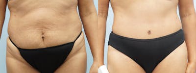 Tummy Tuck Before & After Gallery - Patient 94914666 - Image 1