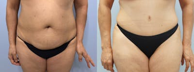 Tummy Tuck Before & After Gallery - Patient 94914724 - Image 1