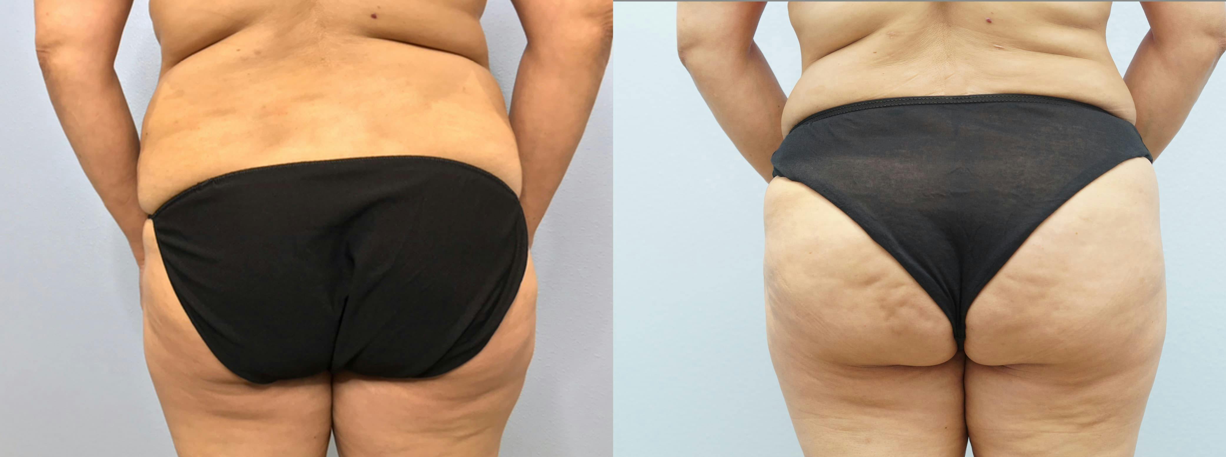 Tummy Tuck Gallery - Patient 94914724 - Image 2