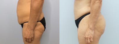 Brazilian Butt Lift Before & After Gallery - Patient 94916492 - Image 1