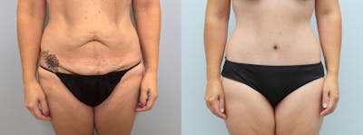Body Lift Before & After Gallery - Patient 94914875 - Image 1