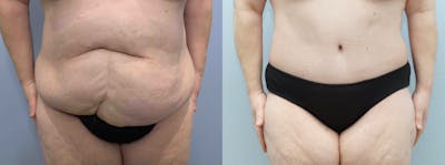Body Lift Before & After Gallery - Patient 94914876 - Image 1