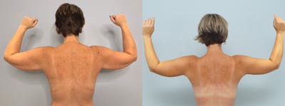 Arm Lift Before & After Gallery - Patient 94915757 - Image 1