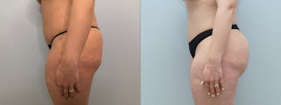 Brazilian Butt Lift Before & After Gallery - Patient 94916448 - Image 1