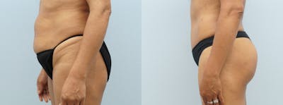 Brazilian Butt Lift Before & After Gallery - Patient 94916484 - Image 1