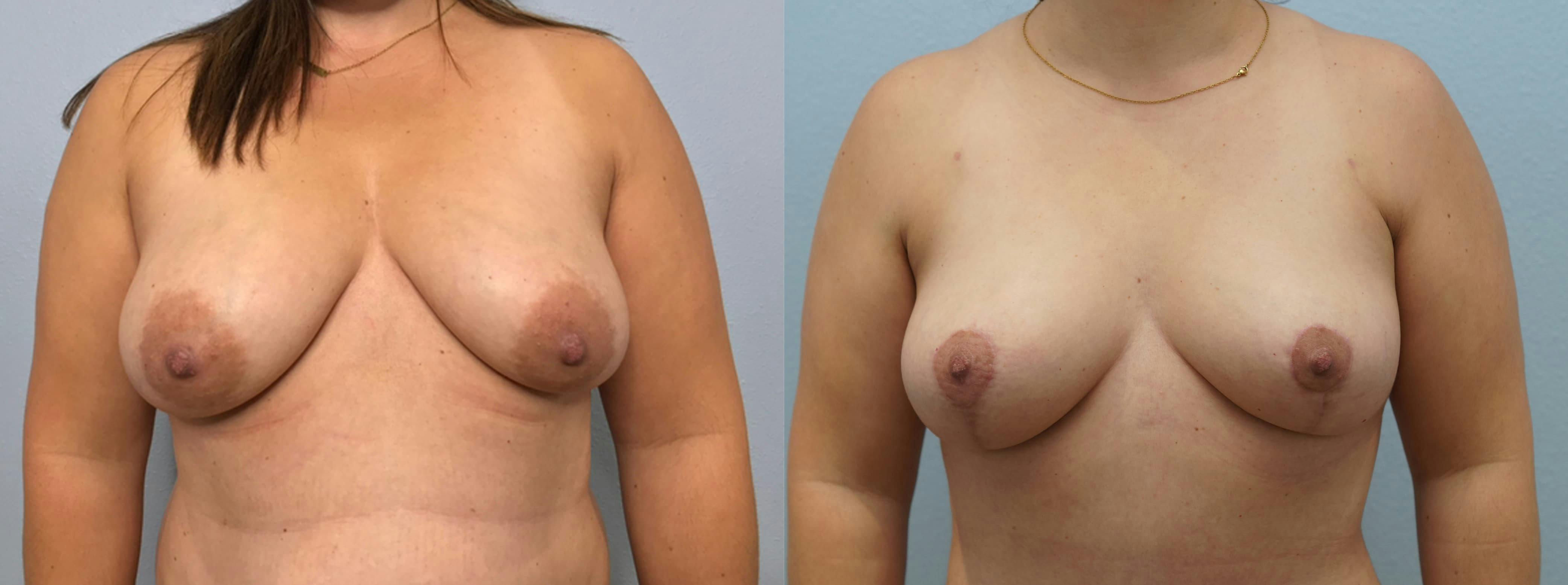 Breast Lift Gallery - Patient 94916571 - Image 1