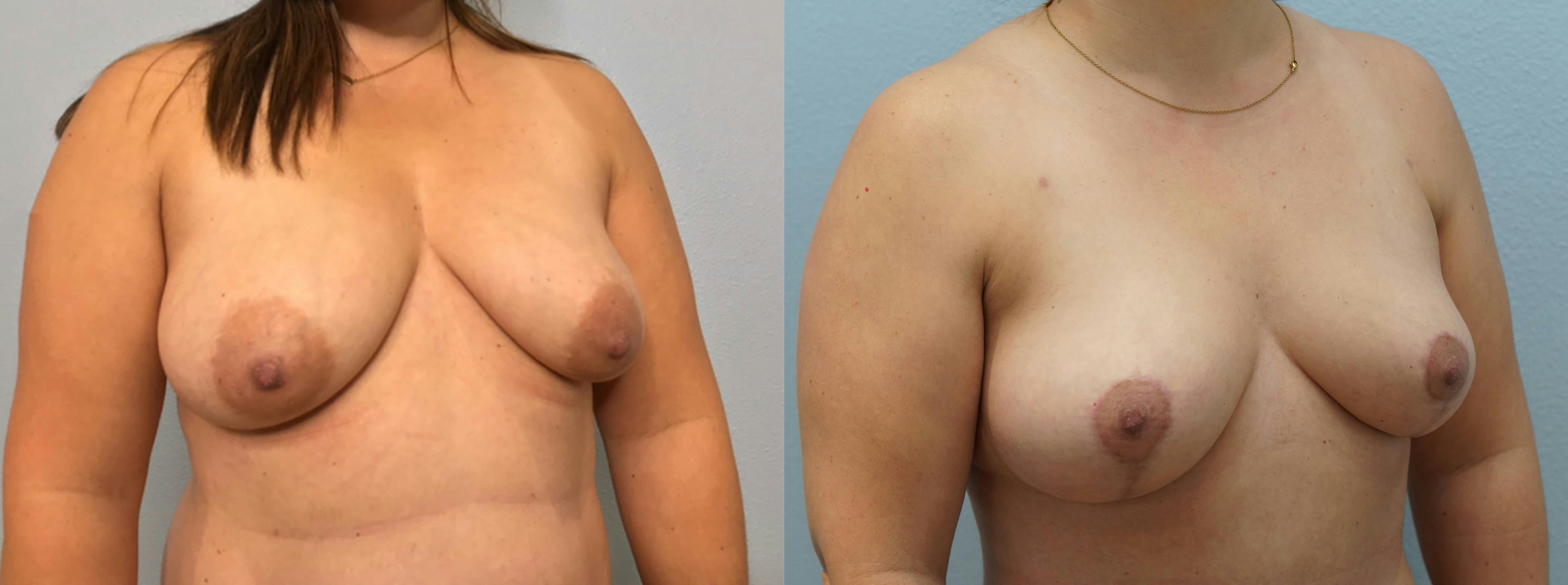 Breast Lift Gallery - Patient 94916571 - Image 4