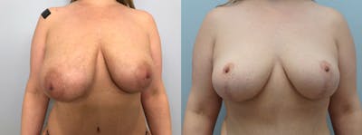 Breast Lift Before & After Gallery - Patient 94916610 - Image 1