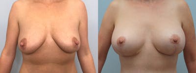 Breast Lift With Implants Before & After Gallery - Patient 94917162 - Image 1