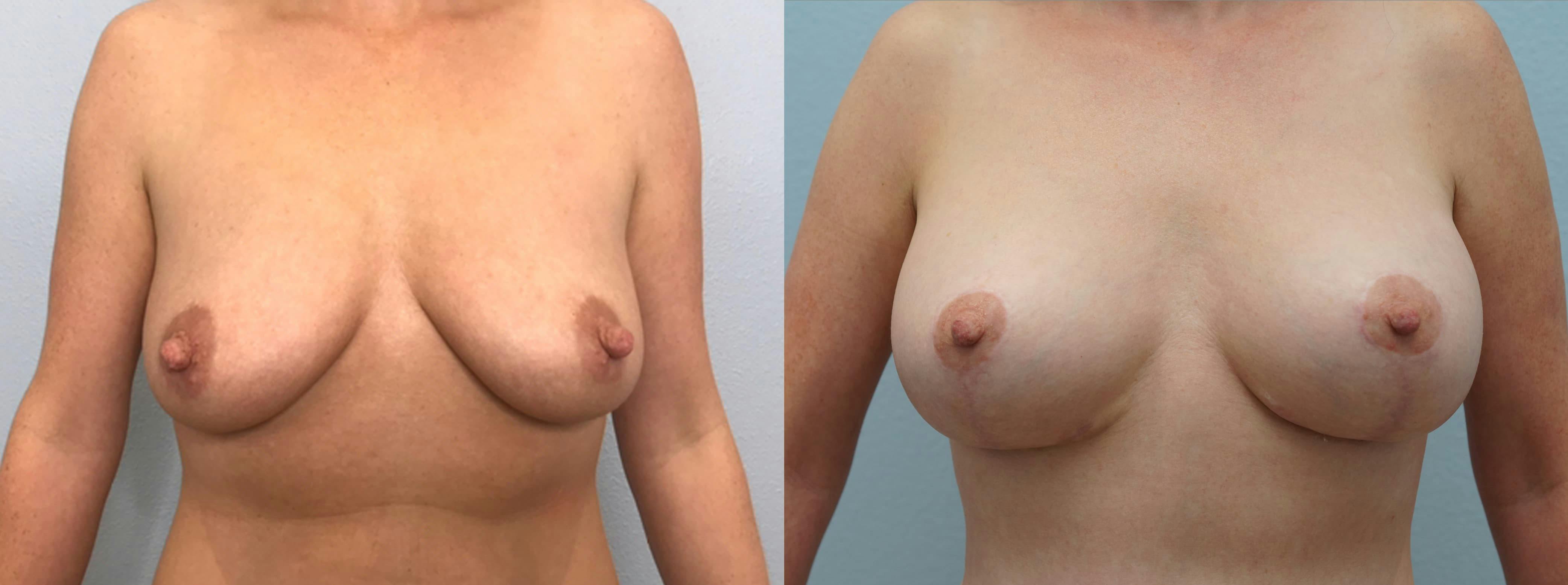 Breast Lift With Implants Gallery - Patient 94917162 - Image 1