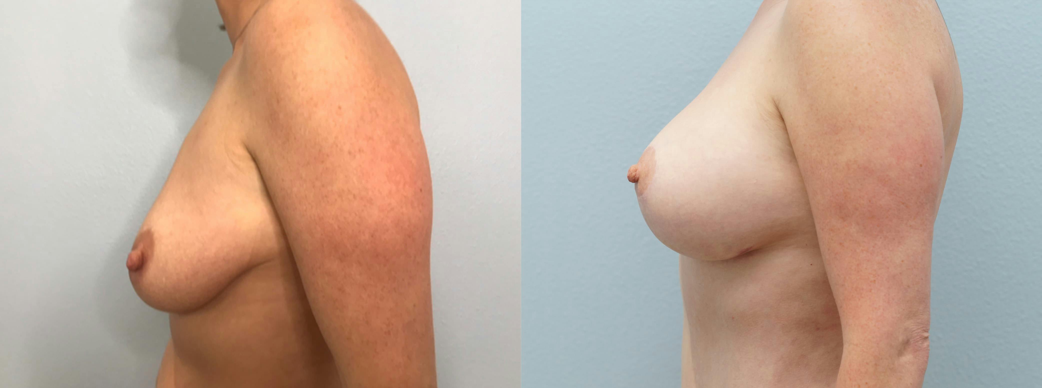 Breast Lift With Implants Gallery - Patient 94917162 - Image 3