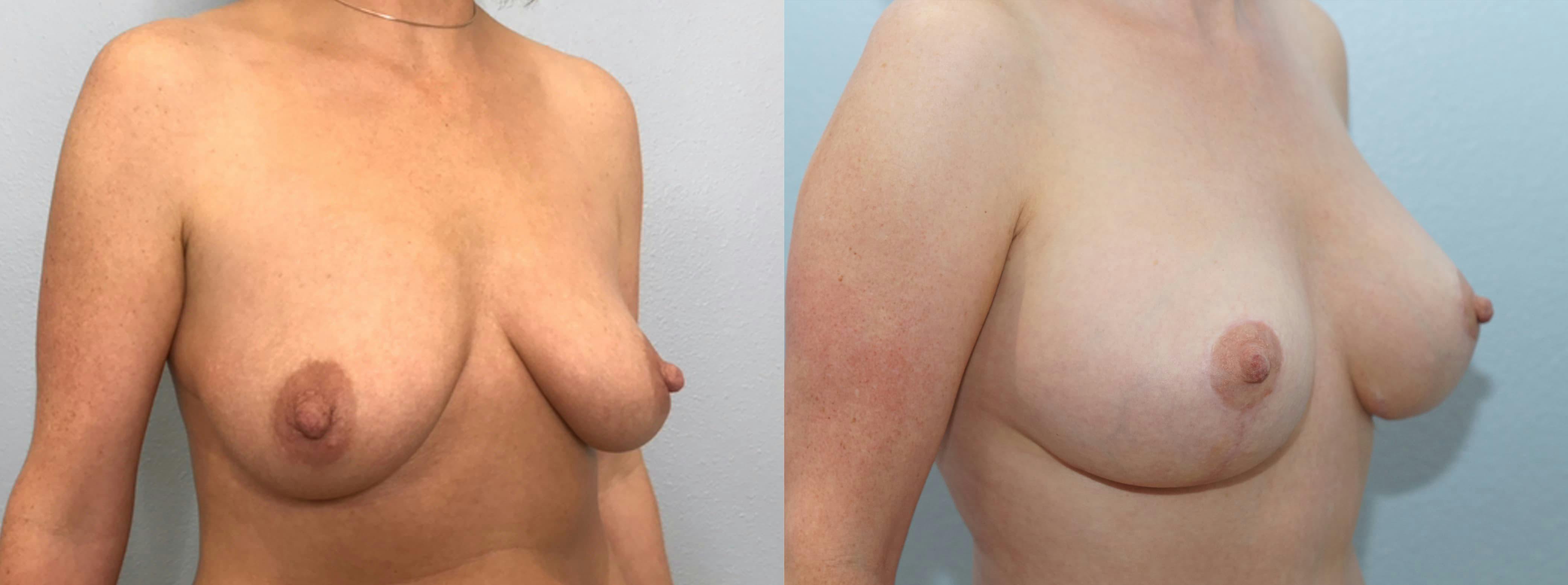 Breast Lift With Implants Gallery - Patient 94917162 - Image 4