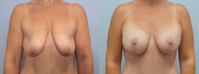Breast Lift With Implants Before & After Gallery - Patient 94917266 - Image 1