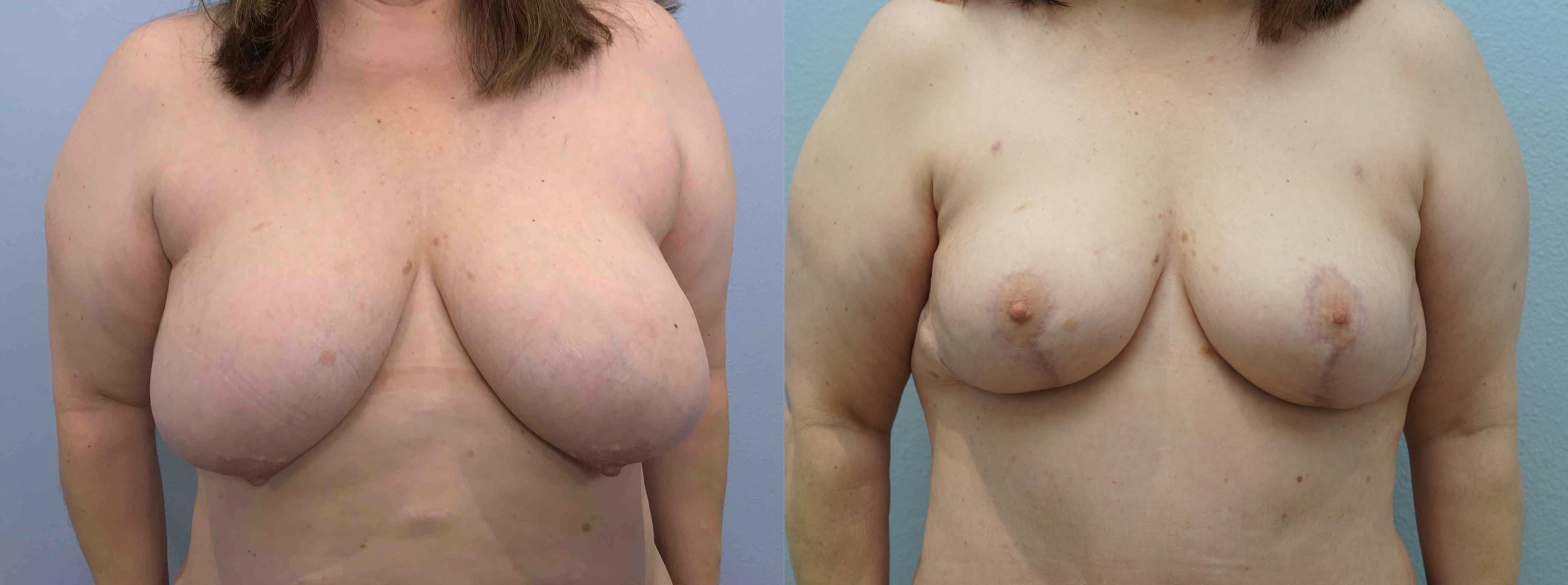 Breast Reduction Gallery - Patient 94917733 - Image 1