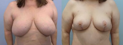Breast Reduction Before & After Gallery - Patient 94917733 - Image 1