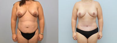 Mommy Makeover Before & After Gallery - Patient 94918226 - Image 1