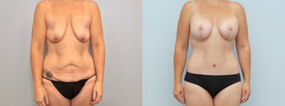 Mommy Makeover Before & After Gallery - Patient 94918248 - Image 1