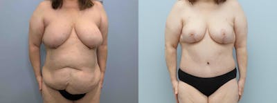 Mommy Makeover Before & After Gallery - Patient 94918268 - Image 1