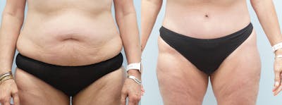 Tummy Tuck Before & After Gallery - Patient 103281630 - Image 1