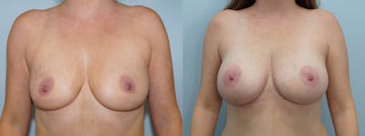 Breast Augmentation Before & After Gallery - Patient 103282291 - Image 1