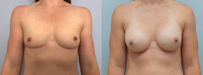 Breast Augmentation Before & After Gallery - Patient 103282397 - Image 1