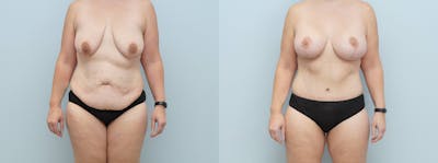 Mommy Makeover Before & After Gallery - Patient 113507056 - Image 1