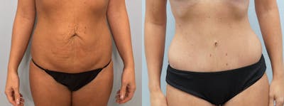 Tummy Tuck Before & After Gallery - Patient 113507267 - Image 1