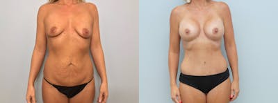 Mommy Makeover Before & After Gallery - Patient 113507376 - Image 1