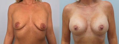 Breast Augmentation Before & After Gallery - Patient 113507413 - Image 1
