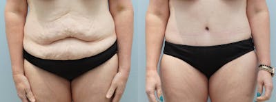 Body Lift Before & After Gallery - Patient 113508612 - Image 1