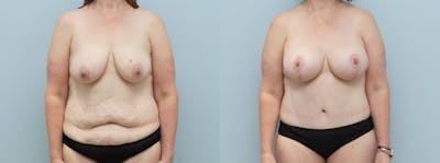 Mommy Makeover Before & After Gallery - Patient 113511252 - Image 1