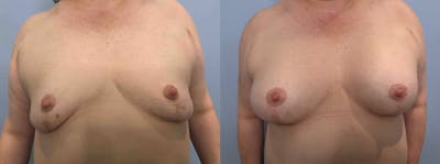 Breast Augmentation Before & After Gallery - Patient 113515962 - Image 1