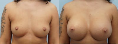 Breast Augmentation Before & After Gallery - Patient 113515988 - Image 1