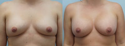 Breast Augmentation Before & After Gallery - Patient 113516008 - Image 1