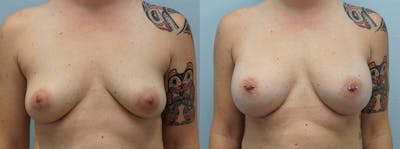 Breast Augmentation Before & After Gallery - Patient 113516028 - Image 1