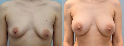 Breast Augmentation Gallery - Patient 113516206 - Image 1